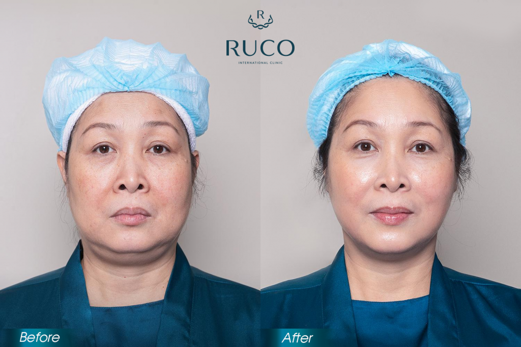 before after ultherapy ruco international clinic hong van