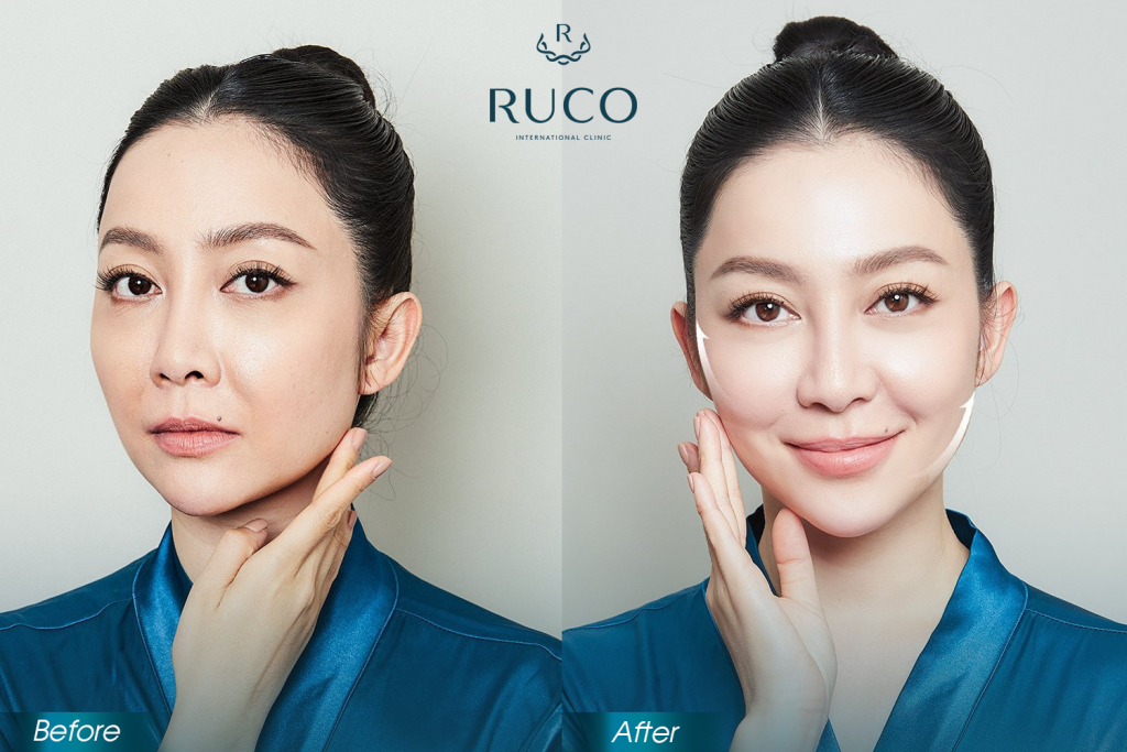 before after ultherapy ruco international clinic linh nga