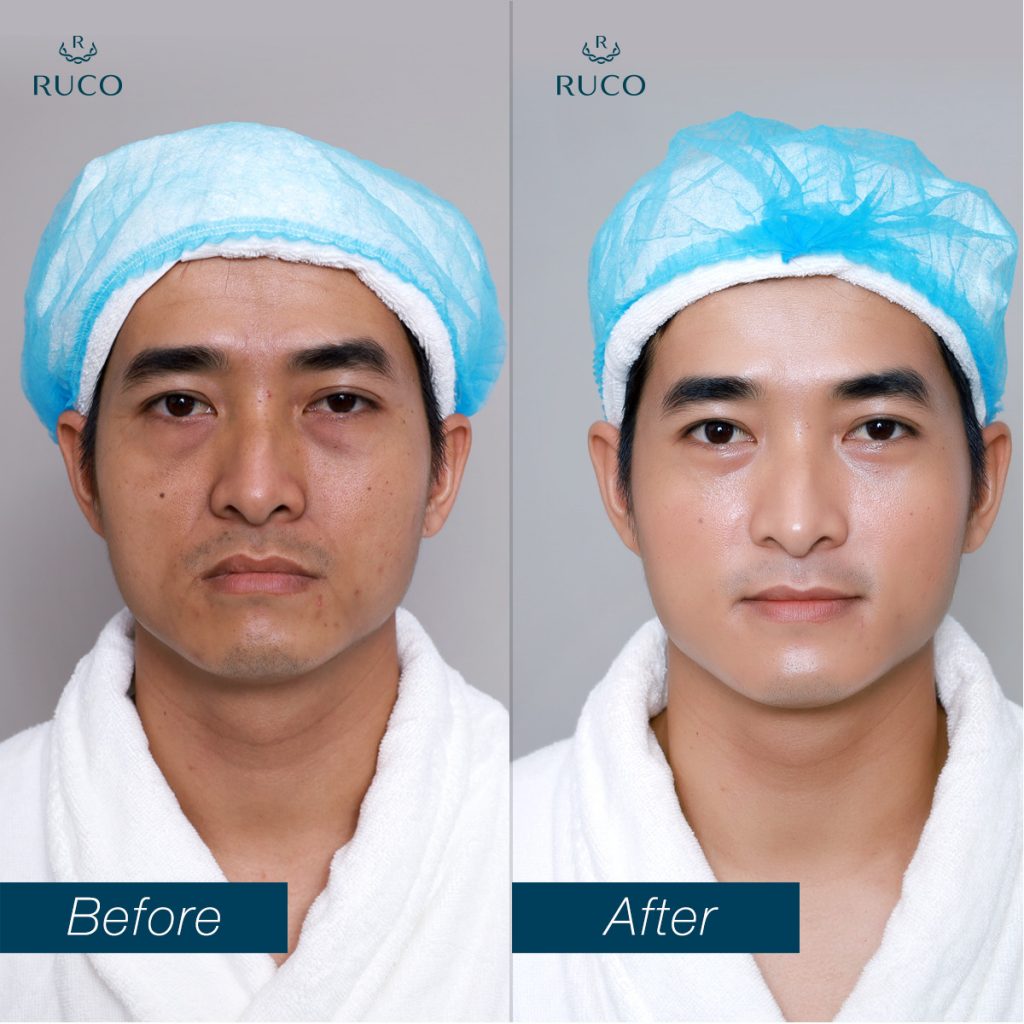 Làn da nam giới được cải thiện rõ rệt sau khi trải nghiệm cùng Magic Lifting 4D và Cấy Khoáng Trung Đông trẻ hóa da cho nam tại RUCO.