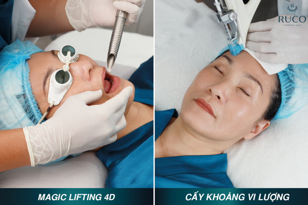 Hồng Đào điều trị trẻ hóa da bằng liệu pháp Cấy Khoáng Vi Lượng Kết Hợp Magic Lifting 4D