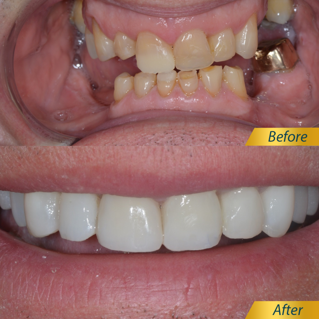 Răng đều đẹp sau khi trồng implant