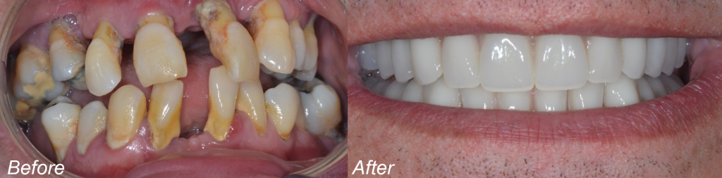 Hình ảnh so sánh răng trước và sau khi phục hình nguyên hàm bằng phương pháp cấy ghép Implant