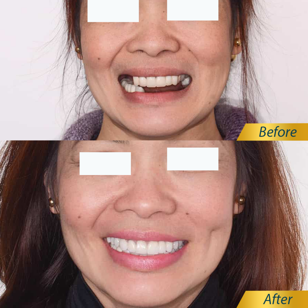 Hình ảnh khách hàng trước và sau khi thực hiện cấy ghép Implant