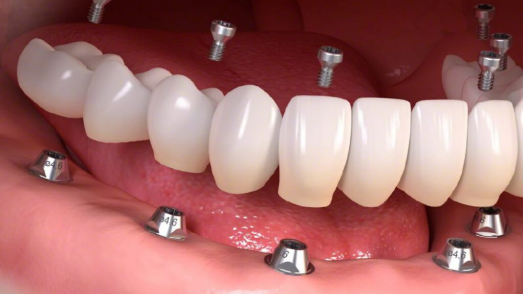 Cấy ghép răng Implant nguyên hàm