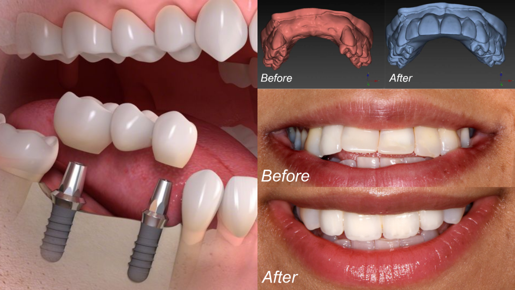 cấy ghép Implant thay thế nhiều răng