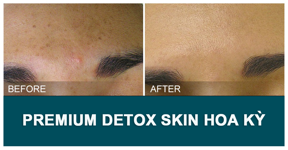 premium detox skin hoa kỳ before after 1