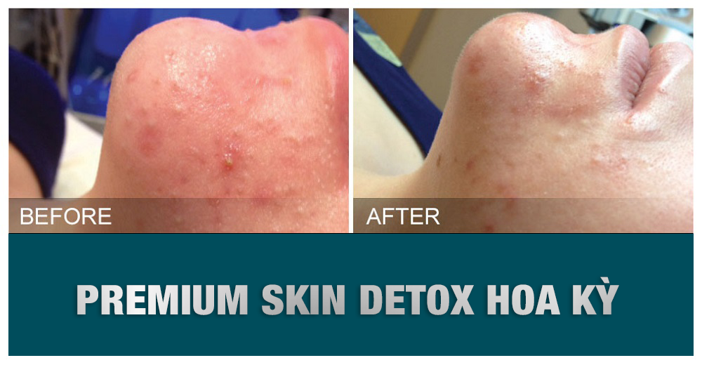premium skin detox hoa ky before after 3
