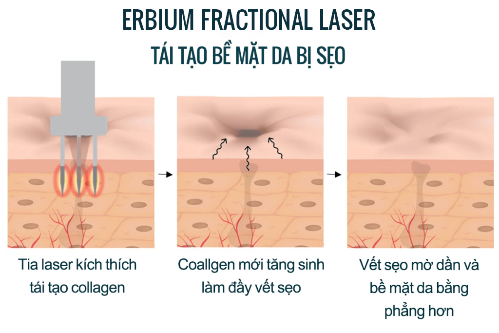 cơ chế trị sẹo rỗ của laser erbium fractional