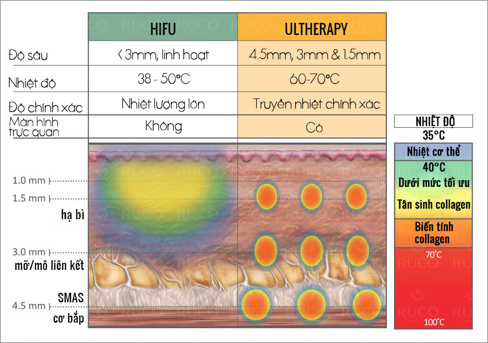 nhiệt độ tác động của ultherapy vs hifu