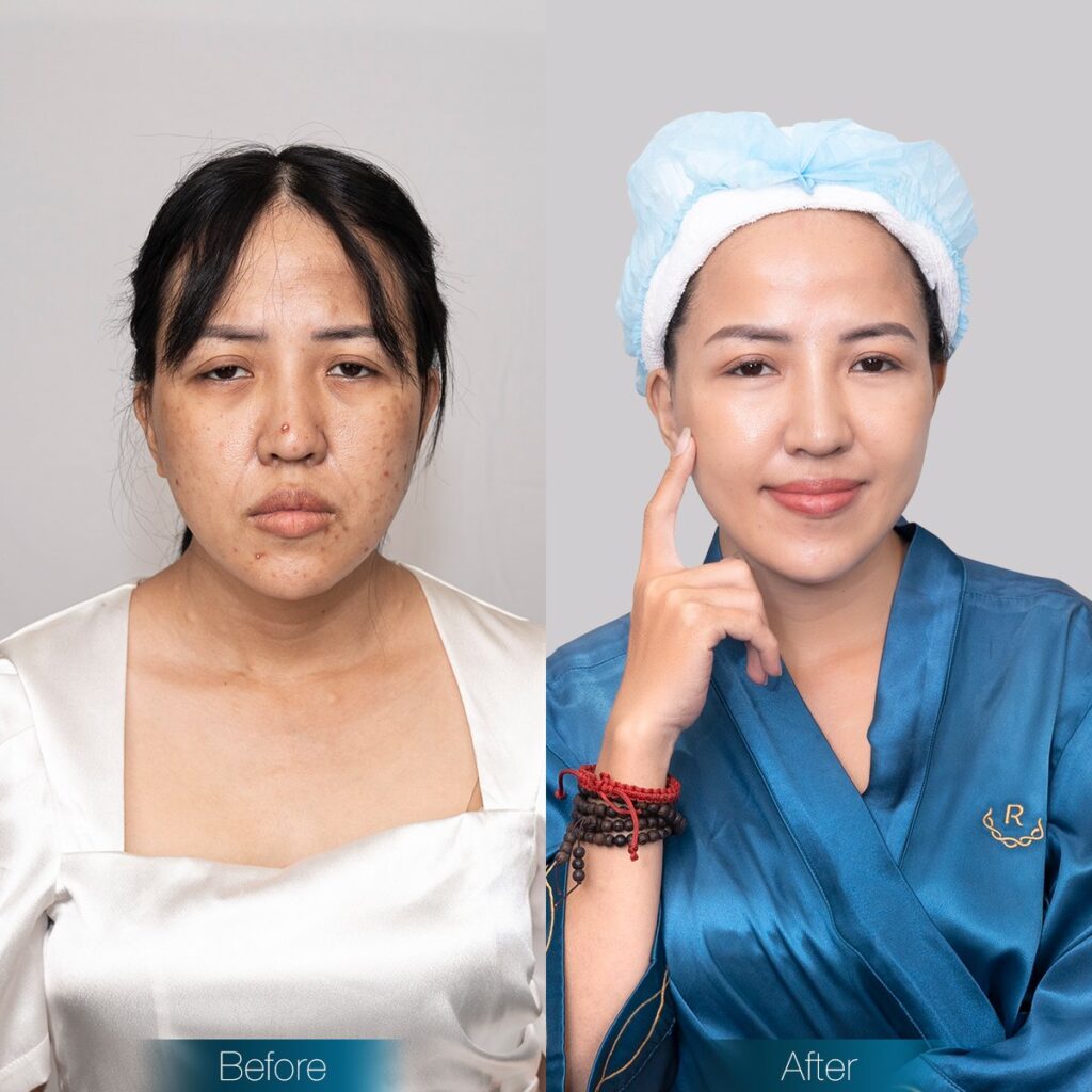 before after nữ gymer 8x sau thermage x6 ruco