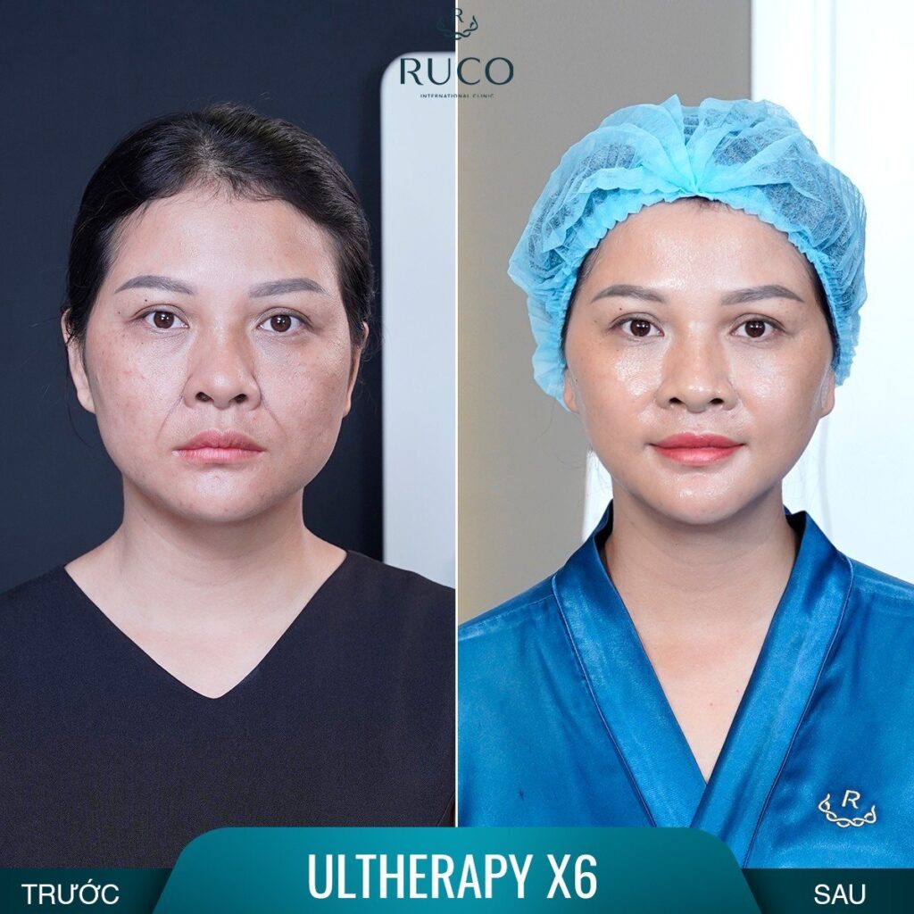 before after ultherapy x6 ruco 3