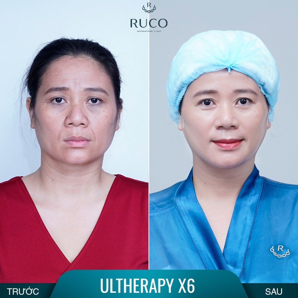before after ultherapy x6 ruco 2