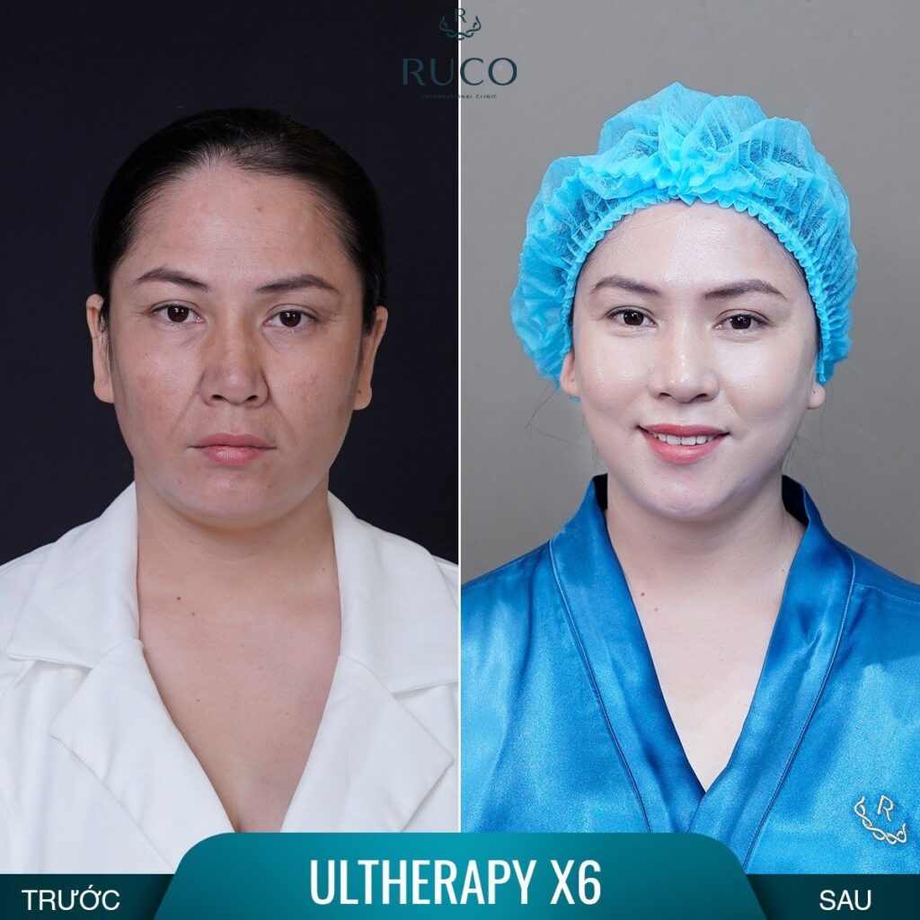 before after ultherapy x6 ruco 1